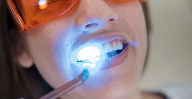 wybielanie zębów w Świdniku